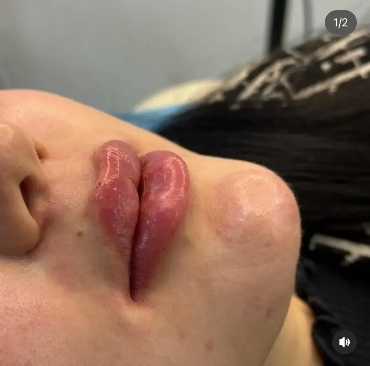 Comblement des lèvres — volume harmonisé