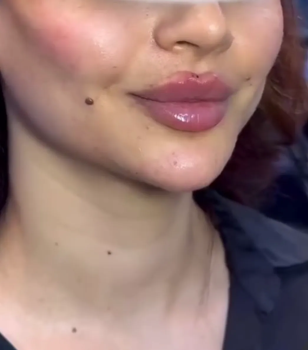 Après soin skin booster — peau repulpée